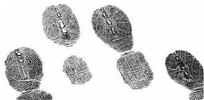 - Notice the scarring on the fingertips